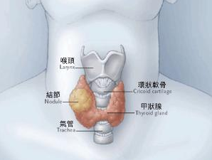 甲状腺癌的发病与放射性损伤有多大关系