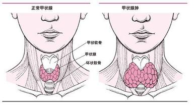 甲状腺癌能吃海鲜吗_早期甲状腺癌能治好吗_女人与公狗能配种吗