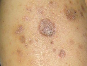尤其是粘膜的鳞状细胞癌往往容易转移.治疗皮肤癌