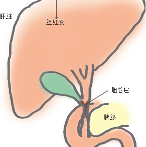 胆囊的病因